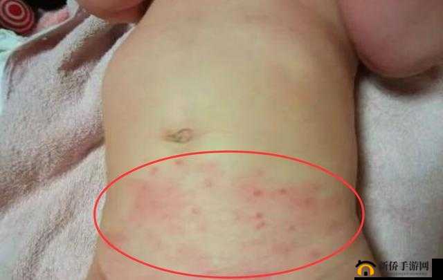 宝宝下面湿透了还嘴硬疼的原因：纸尿裤太厚