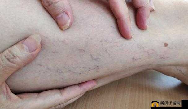 日系裸妆女士静脉曲张：成因及预防措施