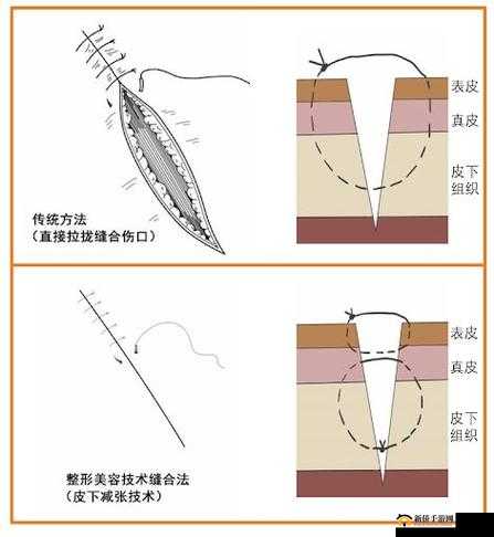 竹板打肿臂缝合不上引担忧