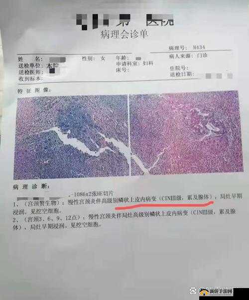 cin3 是什么意思：关于宫颈上皮内瘤变三级的详细解读